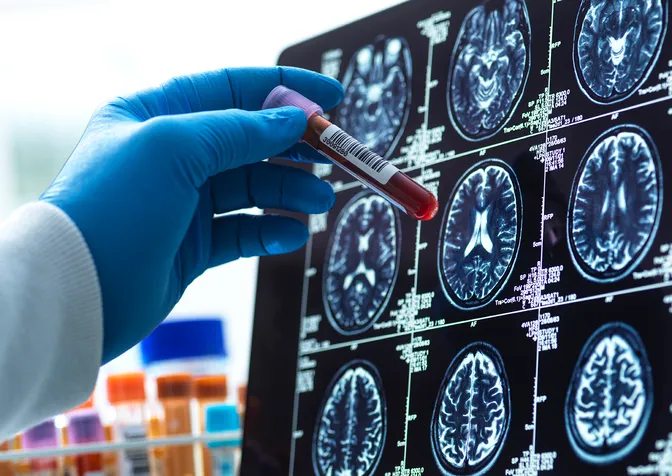 Refus du traitement leqembi en France : la Fondation Vaincre Alzheimer alerte sur une perte de chance pour les patients